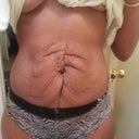 3 days pre op