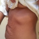 side view 3 days pre op