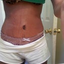 5 weeks post op