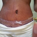 5 weeks post op