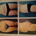 This is 3 mons post op!! Sorry not better quality, but you get the pic!! Remember ONLY my stomach!!