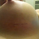post op day 9 scar left boob