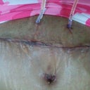 May 26th close up of the incision and drainage tubes.