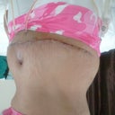 May 26th, Lot of swelling
