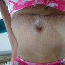May 26th, removed gauze from belly button.