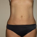 9 weeks post op