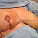 left breast gone