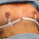 here i am after surgery everything taken away