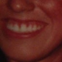 Before juvederm