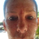 3 hours after procedure