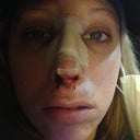 Super bad pic but I want people to know its not glamorous healing