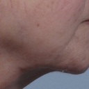 Droopy Chin Repair