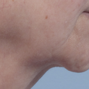 Droopy Chin Repair