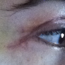 Scar under right eye.