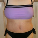Post Op Day 35 (5 weeks)