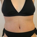 Post Op Day 35 (5 weeks) it's been YEARS since I've been in a two piece!