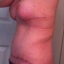 40 days post op - side view