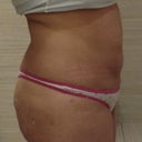 2/2013 Side after 2 babies c-section in june 2012