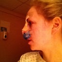 Not long after surgery, my head was banging!