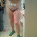 Post-op Day 3 and very happy with what I see so far!