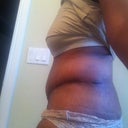 side view; day 28; swelling above the incision