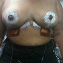 This was one week after surgery, breast not at my waist anymore !!!