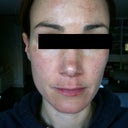 This is day one. The places where I had melasma are darkened, my skin is tight and red.  It feels like a sunburn