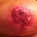 6 weeks post op.  Stiches removed.  Small area where scab came off after shower.  You can see the indent a little from where the gause was. Can't believe the dramatic change!
