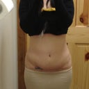 3-1/2 weeks post op. still swelling and feeling chubby front view