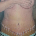 3 Days Post Op