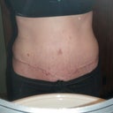 17 Days Post Op