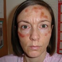 After my 3rd treatment with the new Harmony Laser - DON'T DO IT