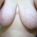 Pre OP...nasty!  Size 40DDD