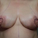 3 Days Post OP