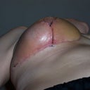 10 Days Post OP - under right breast