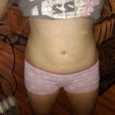 11 days post-op!