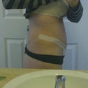 2 weeks post op