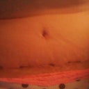 3 weeks PO Incision is healing well.