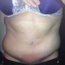 POD 24.  Swollen and back on antibiotics.