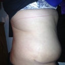 POD 24.  My right side-the scar looks like a little smiley face!  LOLZ!