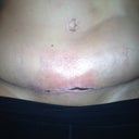 POD 24.  Here is the part of my incision that is not closed yet.  Note the red area that has come back under my BB.