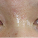 Facial Scar Removal/Treatment