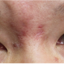 Facial Scar Removal/Treatment