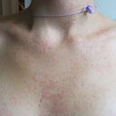 This is what the rash looks like, and it's EVERYWHERE!!