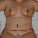 After: day 4, lots of swelling, bruising, and lovely doc markings.