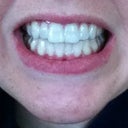 Nice bite still, can't tell they are quite so crooked from this angle. Also, can't tell I'm wearing the aligners, can you?