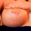 A little over 3 months PO. Disgusting stretch marks and a chunky scar
