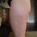 left lateral thigh, the major dimples appear almost frickin' GONE!