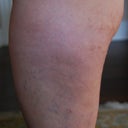 close up left lateral thigh