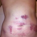 Immediately after the surgery